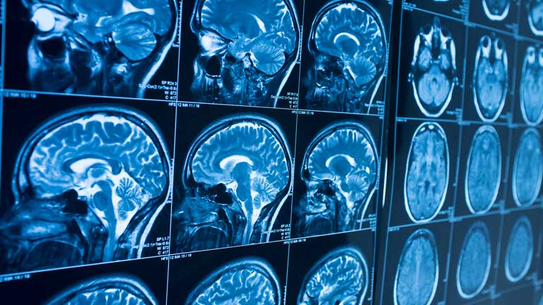X-ray views of a brain X-ray views of a brain